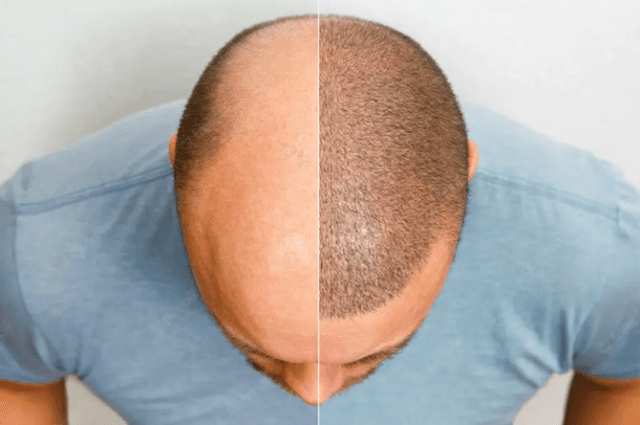 Hair Transplant in Turkey: A Comprehensive Guide