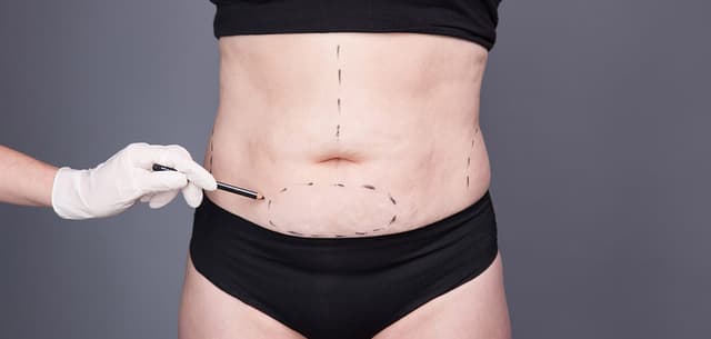 Tummy Tuck After Pregnancy