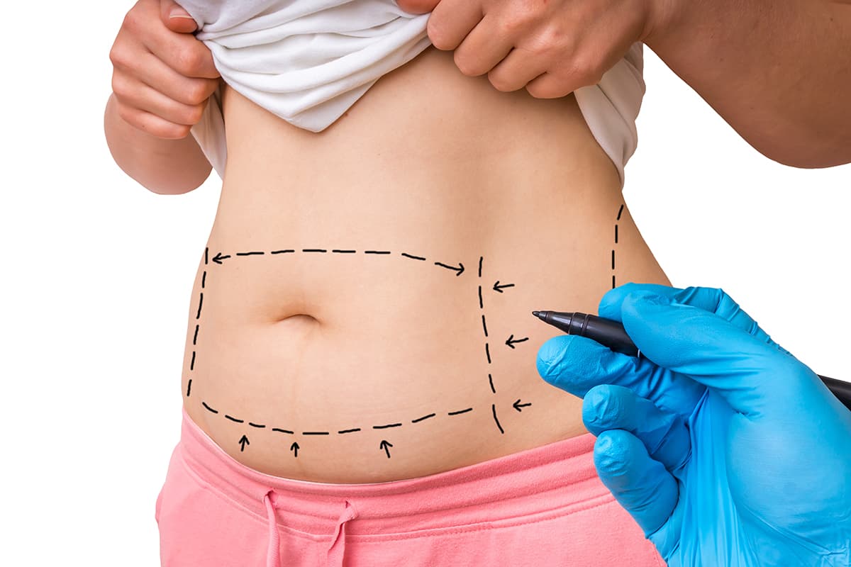 Tummy Tuck