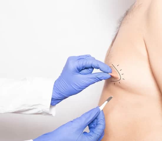 Gynecomastia