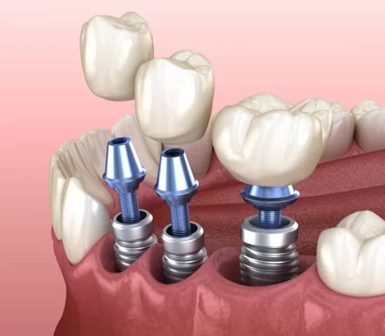 Dental Implant